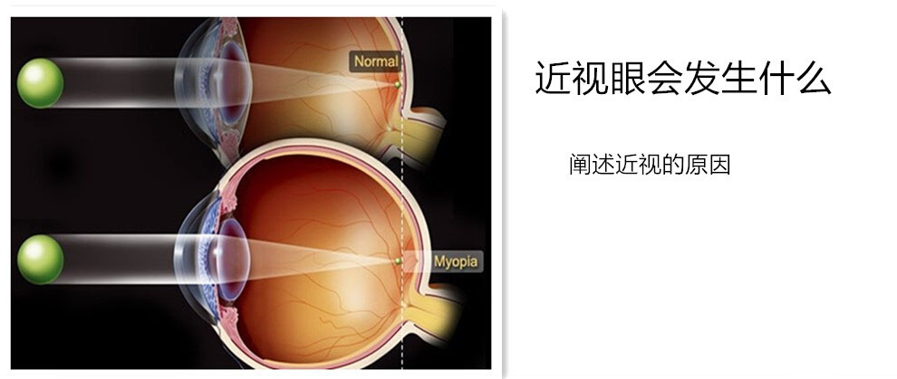 近视眼会发生什么